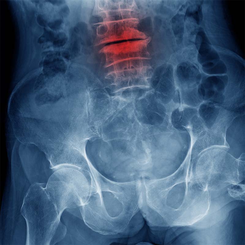 compression fracture lumbar L4 5, S1 level with loss space of di