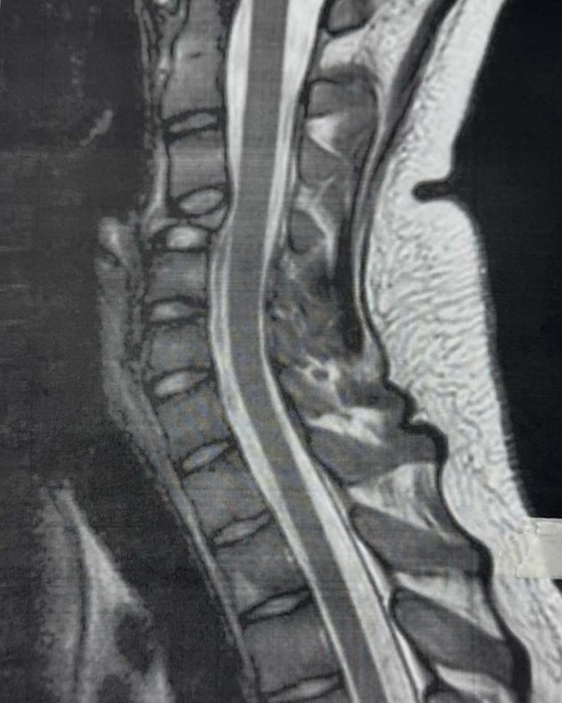 drrobertmeves resseccao tumor 03