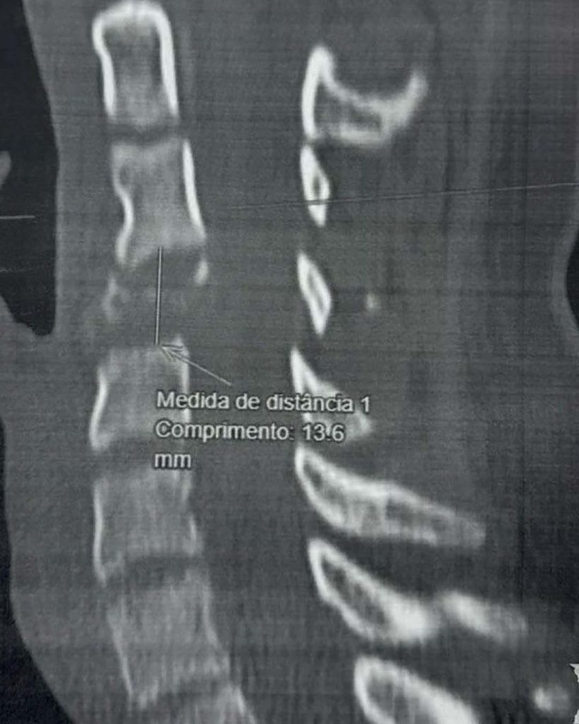drrobertmeves resseccao tumor 04