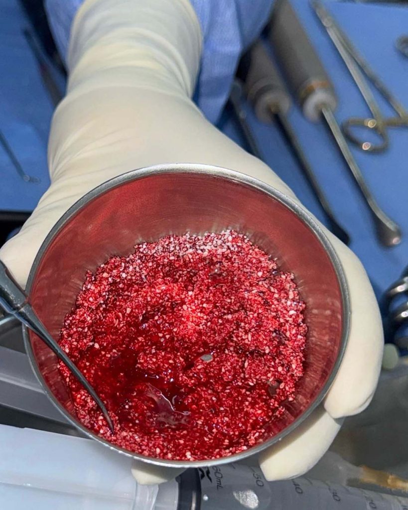 drrobertmeves resseccao tumor 05
