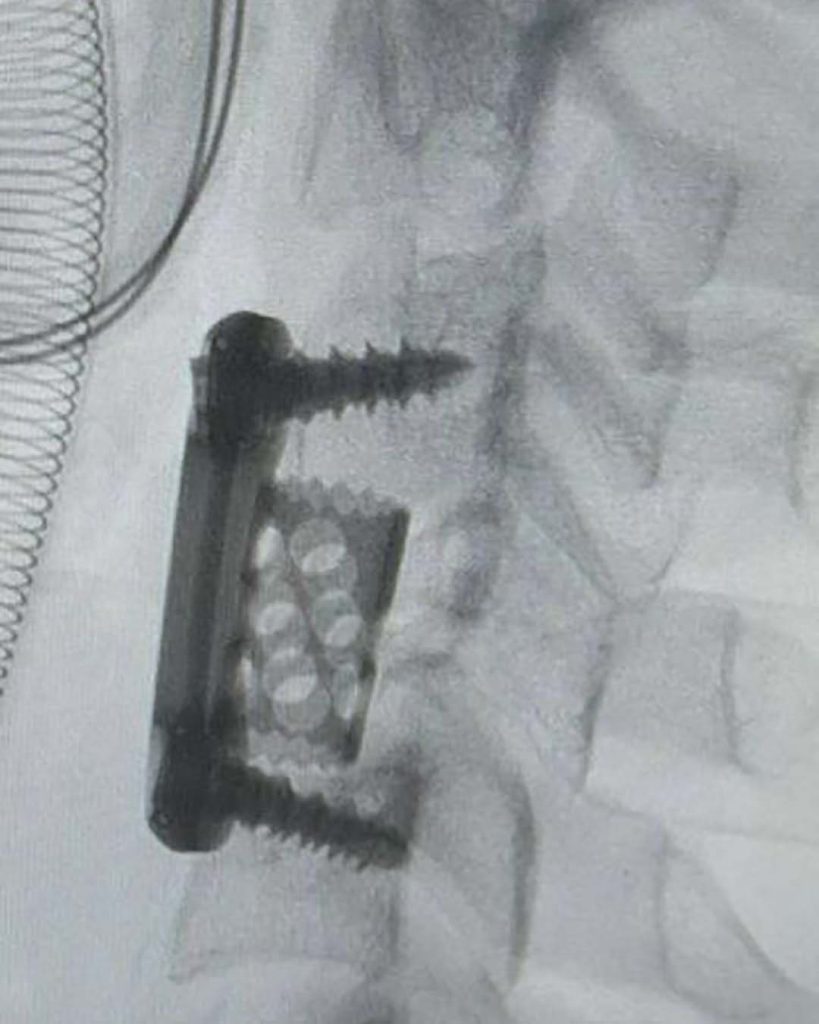 drrobertmeves resseccao tumor 06